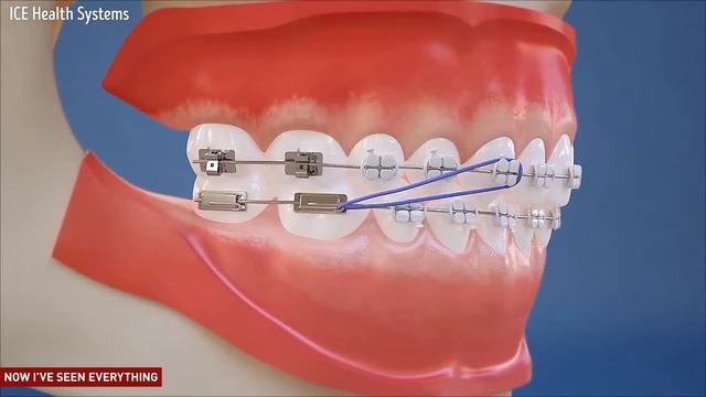 Действие эластичной тяги по 2 классу при лечении патологии прикуса дистальная окклюзия