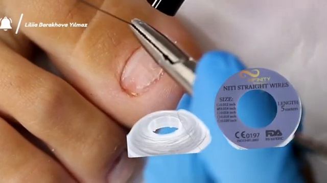 КАК УСТАНОВИТЬ ТИТАНОВУЮ НИТЬ.