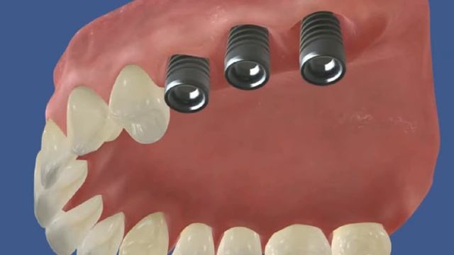 Имплантация   Имплантаты в области дистальных верхних зубов 4 5 6