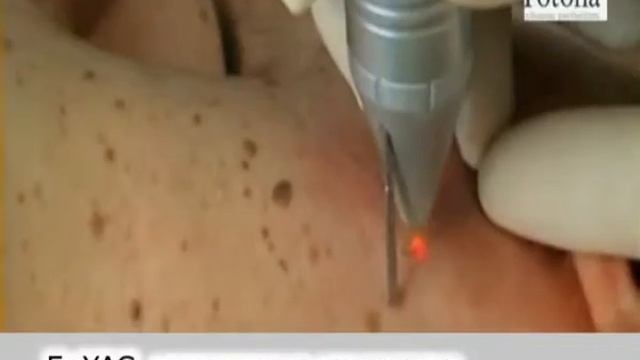 Лазерное удаление пигментации в Пятигорске. смотреть онлайн