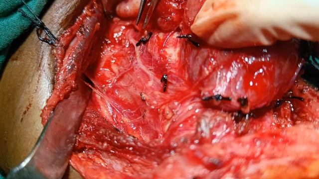 Total Thyroidectomy with Central Neck Dissection : Intraoperative Anatomy & Landmarks. смотреть онлайн