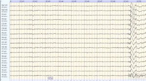 Приступ эпилепсии во время записи ЭЭГ