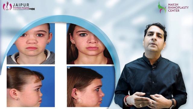 नाक की सर्जरी / राइनोप्लास्टी में कितना खर्च आता हैं? | ✅ Cost of Rhinoplasty | Dr Sunil Tanvar смотреть онлайн