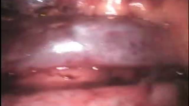 Laparoscopic paraaortal lymph node dissection for ovarian cancer by Dr. Serg Baydo смотреть онлайн