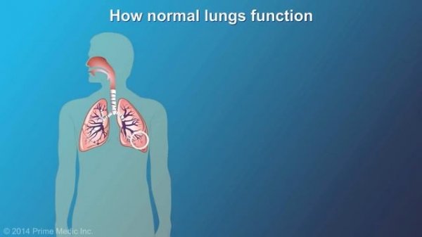 Understanding COPD