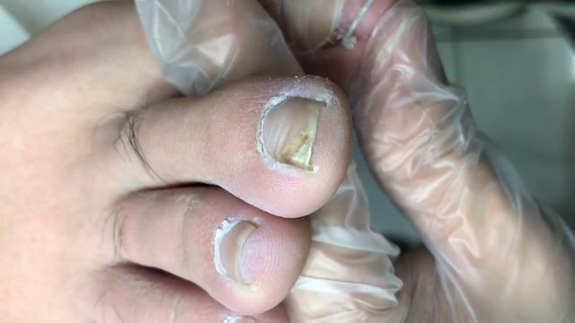 Very Curly Ingrown Nails, Nail Fungus Trim【Dr Zhang】