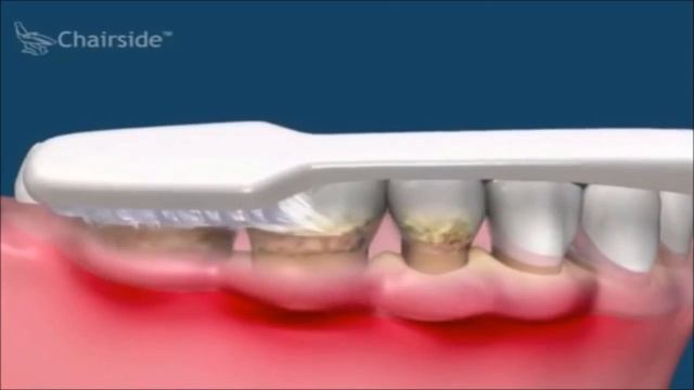 Что будет если плохо чистить зубы? смотреть онлайн