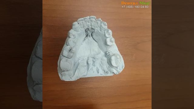 Имплантация зубов. Осложнения при имплантации зубов. Имплантация по шаблону.