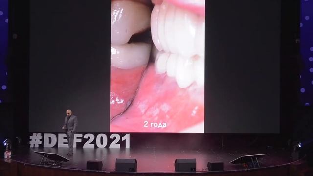 Dr. Bagrat Smbatyan - of hypergrowth of connective tissue grafts смотреть онлайн