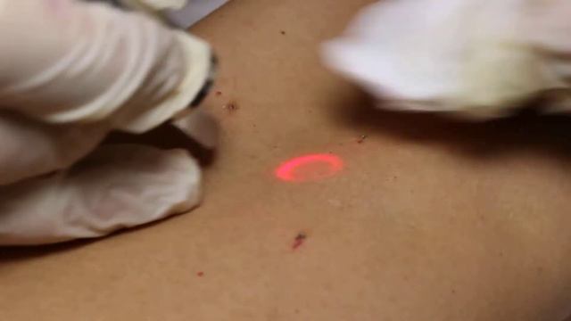 вишневая ангиома Cherry angioma смотреть онлайн