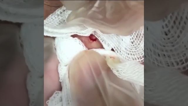 Выдавили гной из мочки на ухе. смотреть онлайн