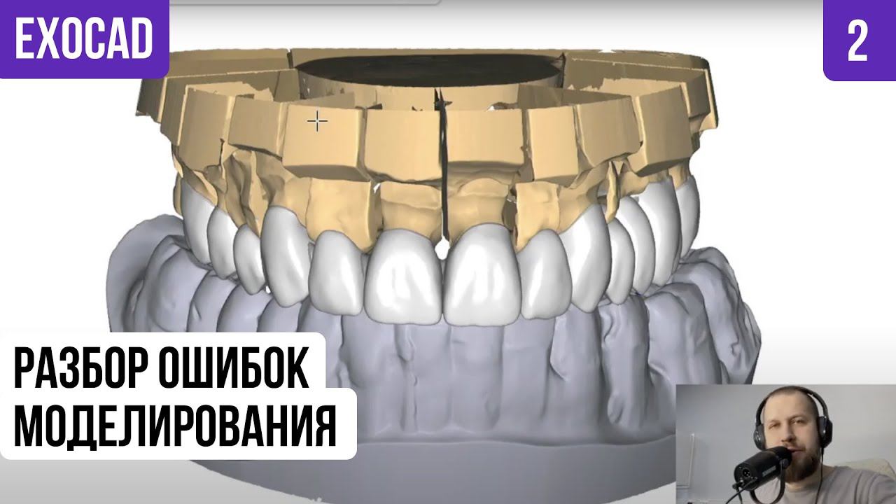Exocad разбор ошибок моделирования реальный клинический случай часть 2