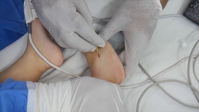 Crying Baby Gets a Deep Sleep Anesthesia for Surgery смотреть онлайн