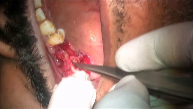 Immediate Implant Placement And Crestal Sinus Lifting Using L PRF