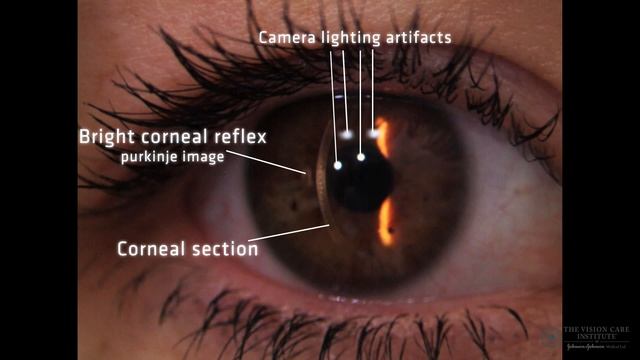 Slit Lamp Techniques Specular Reflection смотреть онлайн