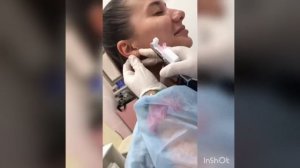 Прокол ушей и хряща  пистолетом системы 75