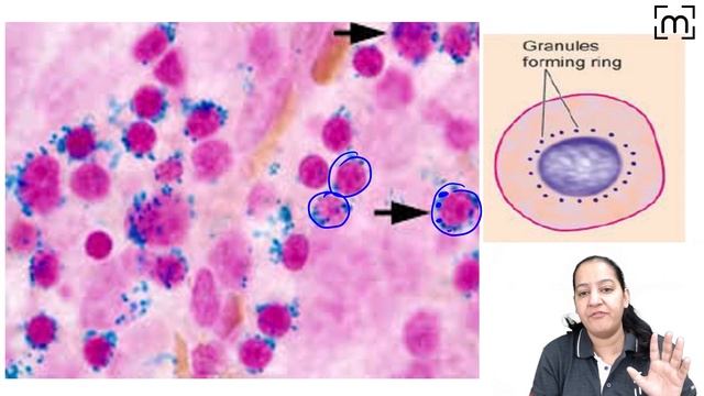 Sideroblastic Anemia | Ring Sideroblast | Prussian Blue Staining | Perl's Stain смотреть онлайн