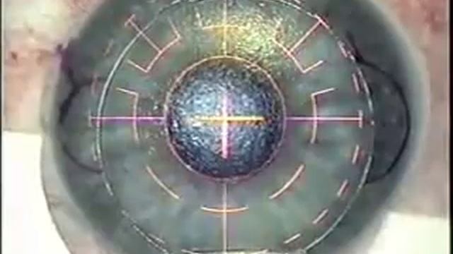 LASIK Eye Surgery, CustomVue Wavefront-guided LASIK смотреть онлайн