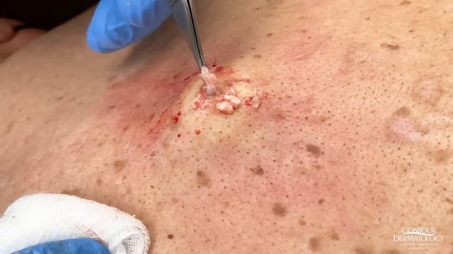 Stubborn Sac And Cyst Removal | CONTOUR DERMATOLOGY