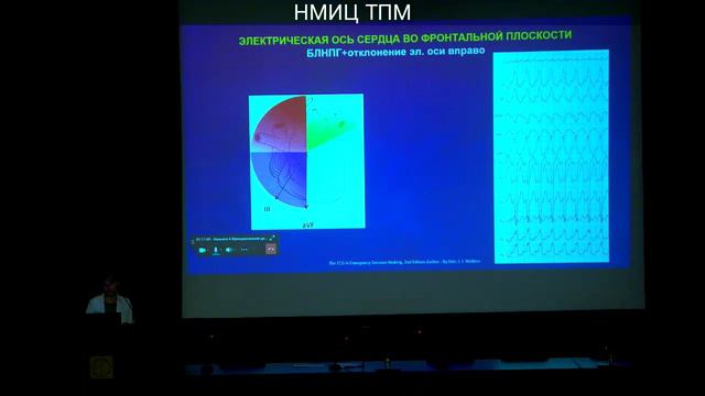 Дифференциальный диагноз тахикардий с уширенными комплексами QRS