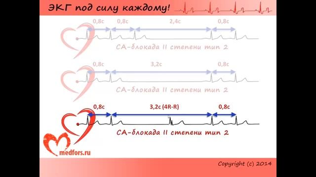 Урок 6 Видеокурс ЭКГ под силу каждому смотреть онлайн