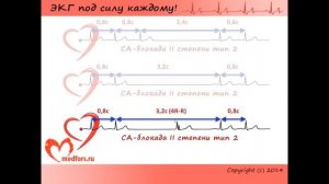 Урок 6  Видеокурс ЭКГ под силу каждому