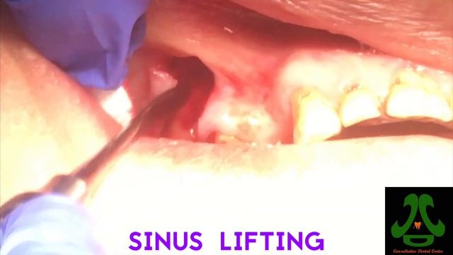 2 Important Tips In Open Sinus Lift Technique.