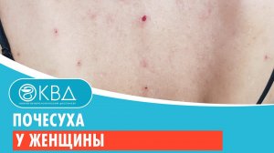 ? Почесуха у женщины. Клинический случай №196