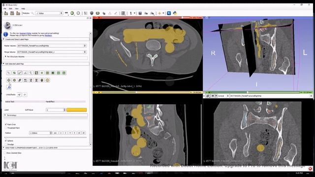 Region Growing Segmentation with 3DSlicer смотреть онлайн