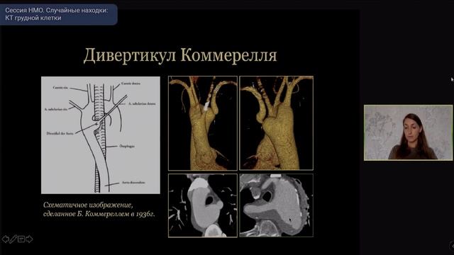 Сессия «Случайные находки: КТ грудной клетки» в рамках второго ФОРУМА Онлайн-диагностика 3.0 (MRO)