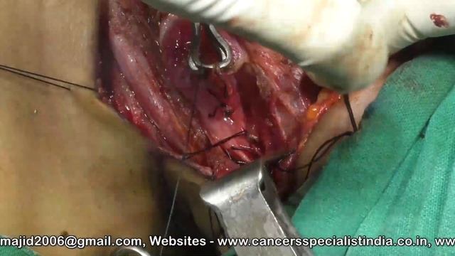 Total Thyroidectomy with Lymph node dissection by dr Majid Talikoti  Team.