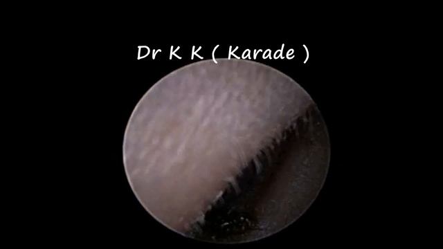 Deep Nose Foreign Body Removal - Bolt in Child смотреть онлайн