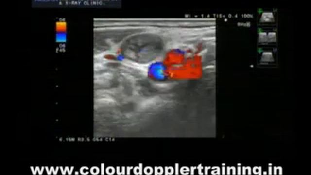 Ultrasound Lymphnode Metastasis in lymphnodes смотреть онлайн
