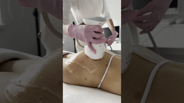Ультразвуковая липосакция Ulfit - Therapy - как убрать живот? Убираем галифе и целлюлит | GEN87 смотреть онлайн