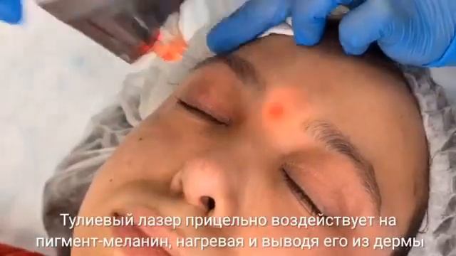 Фракционный лазер ResurFX смотреть онлайн