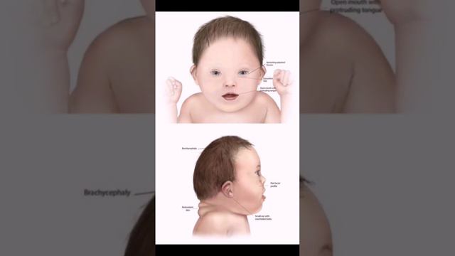 на УЗИ не всегда можно увидеть синдром Дауна т.к не все значимые маркеры могут присутствовать смотреть онлайн
