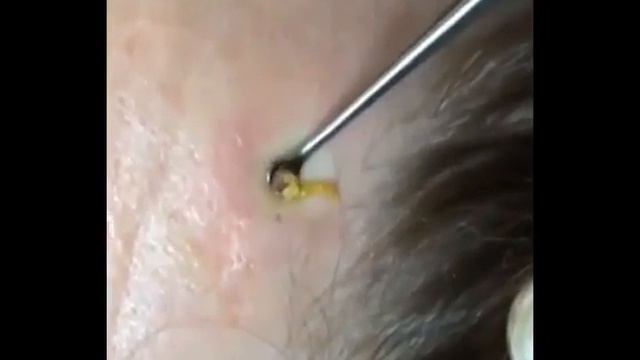Подборка мерзостей,угри,прыщи,черные точки/A selection of abominations,blackheads,pimples,black dot смотреть онлайн