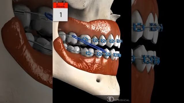 Braces: Anterior Crossbite (Class III) смотреть онлайн