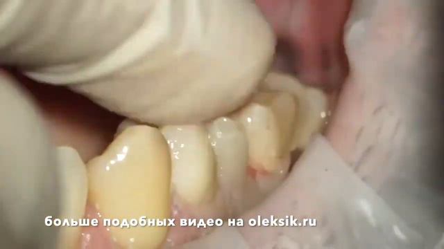 Препарирование 🦷, моделирование временной коронки, 15 зуб 🦷 Автор: Артём Олексик смотреть онлайн