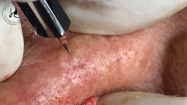 #256 | Huong Da Nang - Super Big Acne Part 1 смотреть онлайн