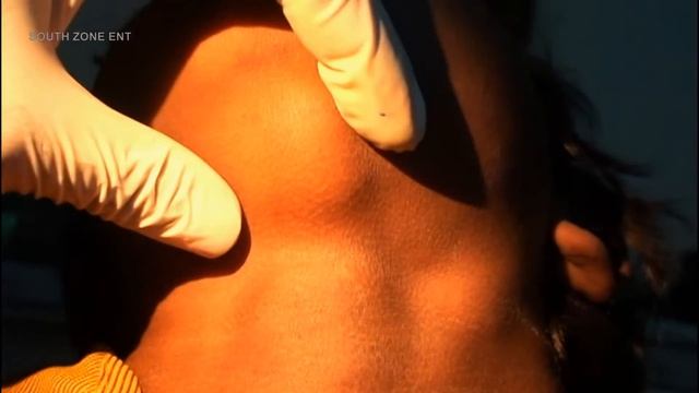 SUB MENTAL SWELLING смотреть онлайн