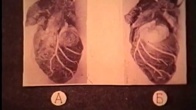 Дилятация левого желудочка сердца (без звука) © ischemic dilation of the heart, soundless смотреть онлайн