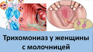 Трихомониаз у женщины с молочницей