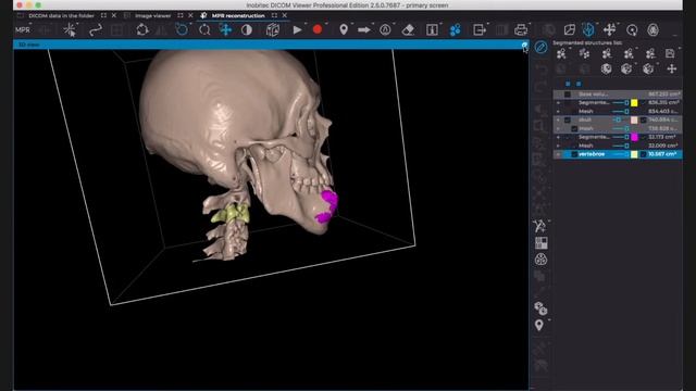 3D Biomodeling and Segmentation in Inobitec DICOM Viewer Pro смотреть онлайн