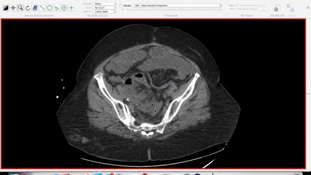 | GIT | IO | Trans-mesosigmoid internal hernia | смотреть онлайн