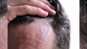 Симптомы и первые признаки псориаза: фото у женщин, мужчин и детей