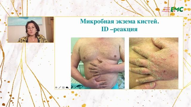4. Экзема. Тактика ведения пациентов. Ольга Борисовна Тамразова смотреть онлайн