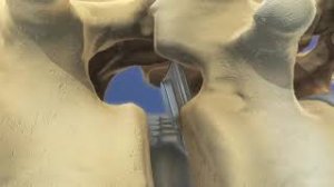 Установка межтелового фиксатора Баррикейд