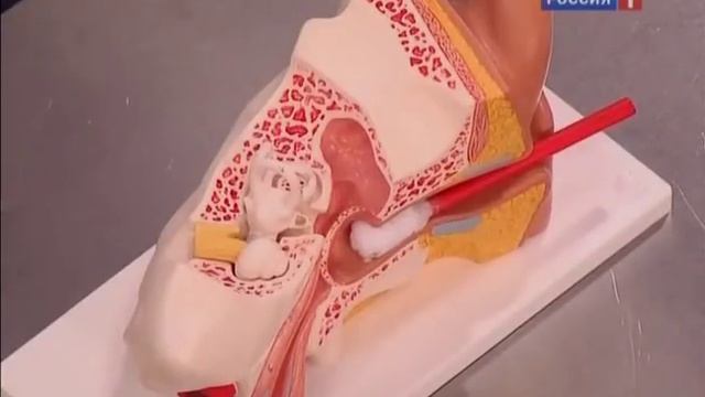 Как правильно чистить уши ребенку и взрослому? Серная пробка в ухе и другие опасности смотреть онлайн