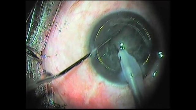 Phaco in a Soft Cataract Chip & Flip смотреть онлайн